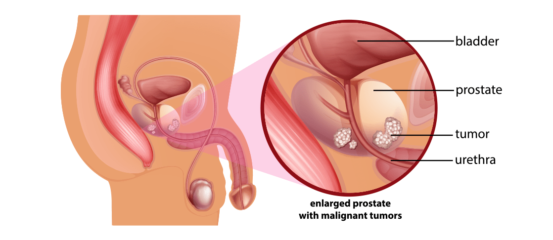 Prostat Kanseri Tedavisi